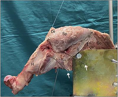 The Arthroscopic Intra-Articular Stabilization of the Shoulder for Irreparable Rotator Cuff Tear: A New Technique Proposal